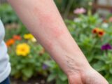 Juckender Hautausschlag nach Gartenarbeit behandeln
