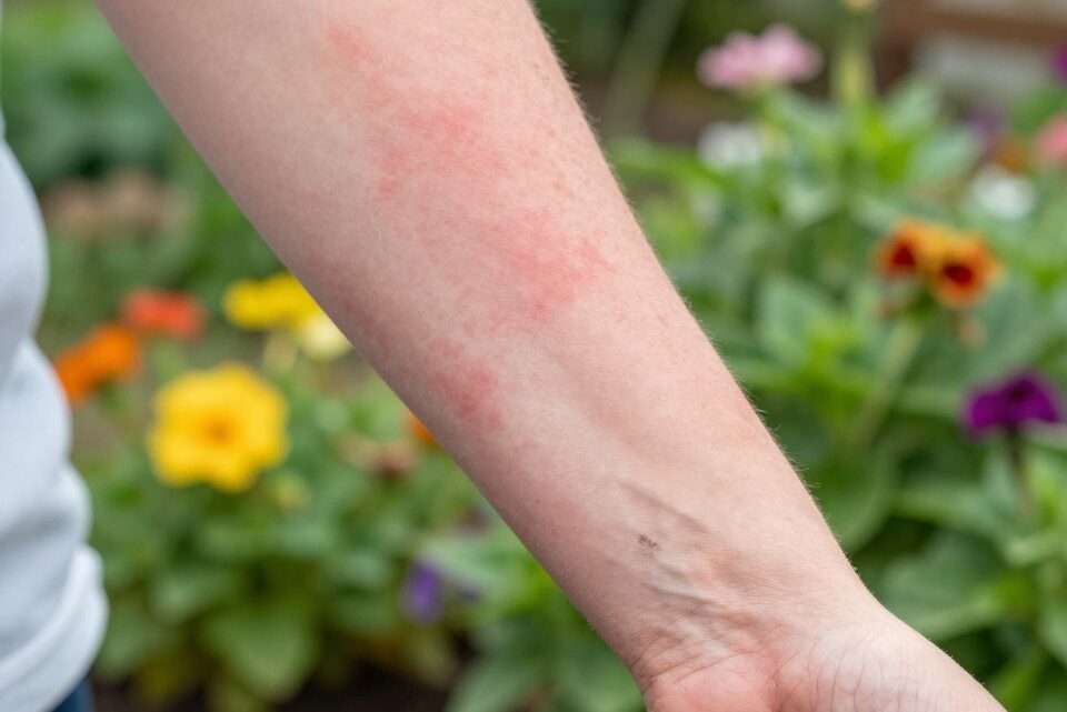 Juckender Hautausschlag nach Gartenarbeit behandeln